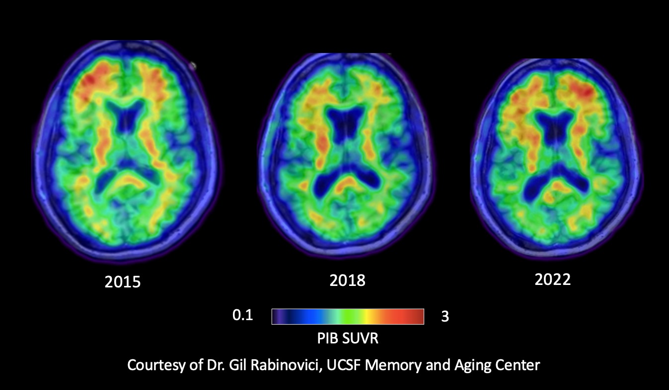 Brain PET scan